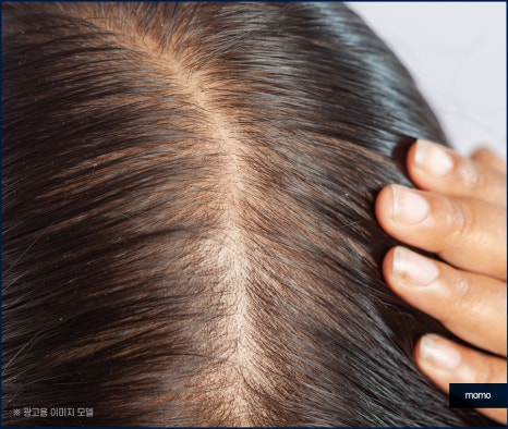 여자 m자 이마 헤어라인 모발이식으로 교정 관련 이미지 9
