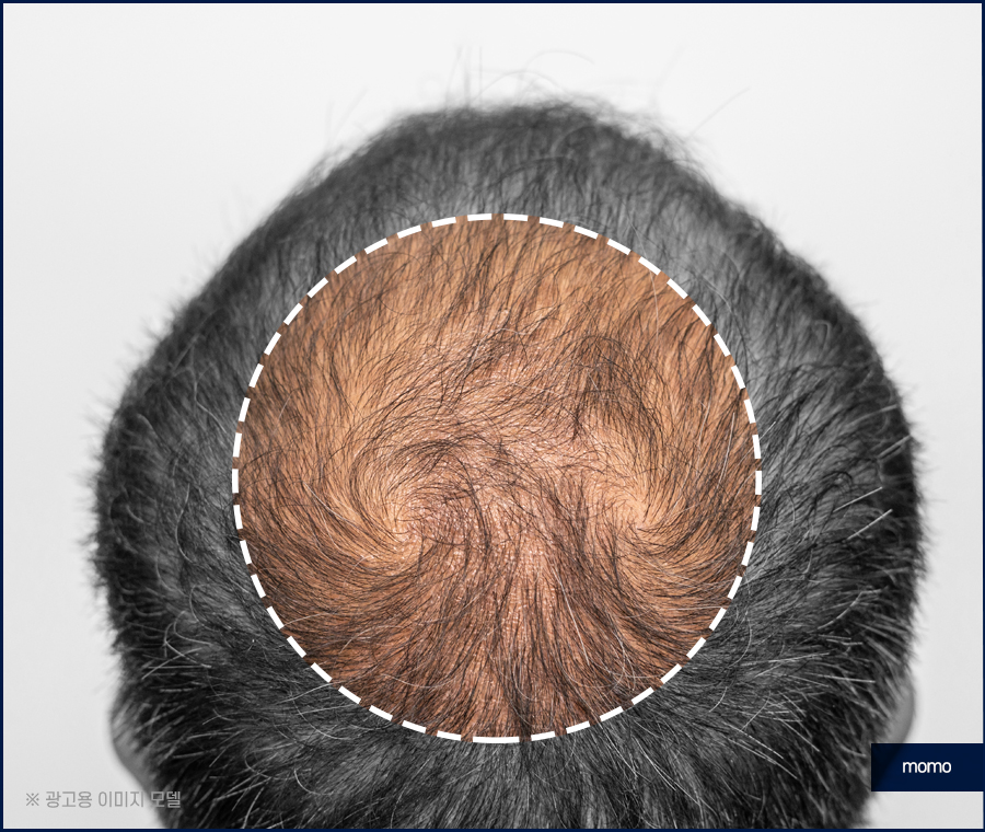 무삭발 모발이식 빠르게 회복하려면 관련 이미지 9