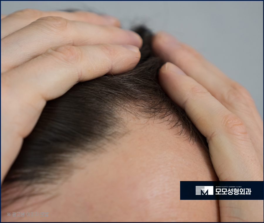 여자헤어라인모발이식 정돈된 미모를 완성하는 방법 관련 이미지 4