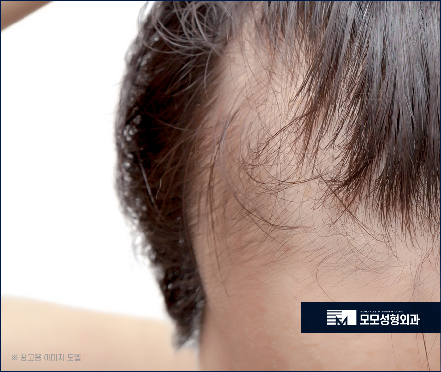 신사동 모발이식 헤어스타일을 자유롭게 연출하기 위한 관련 이미지 3