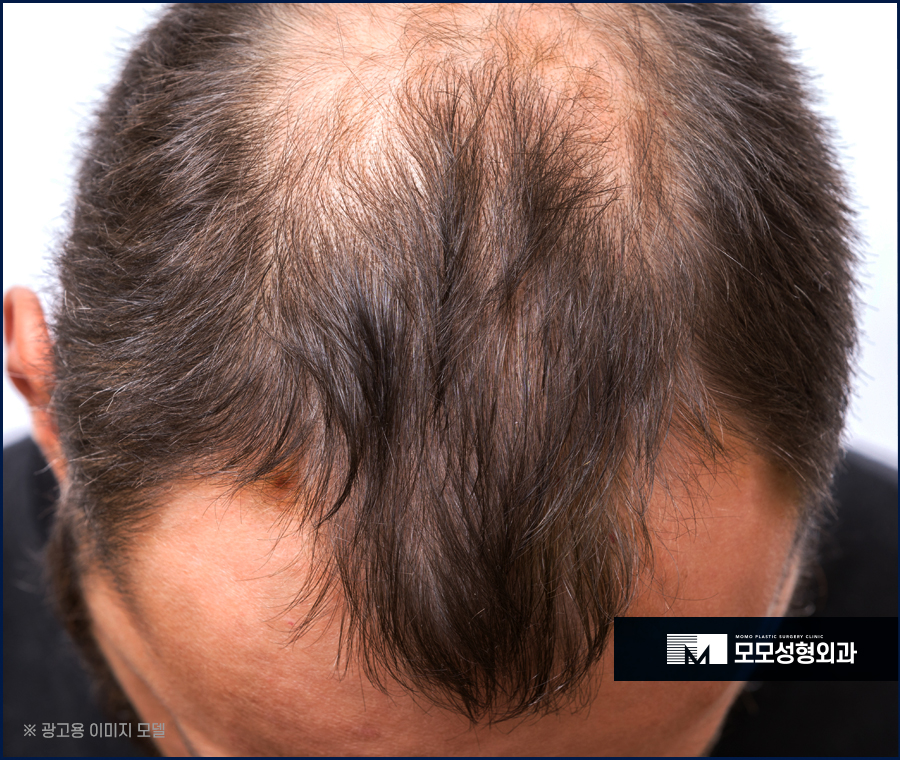 M자모발이식가격 참고해야 할 사항은 관련 이미지 3