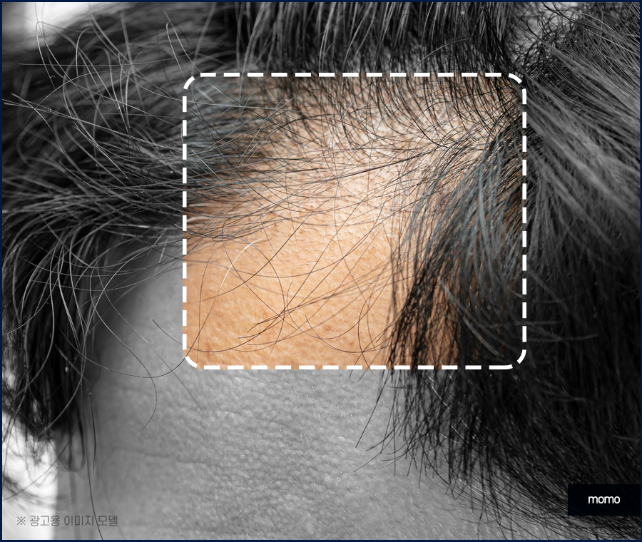 비절개 모발이식 비용 개인차를 고려해서 관련 이미지 7