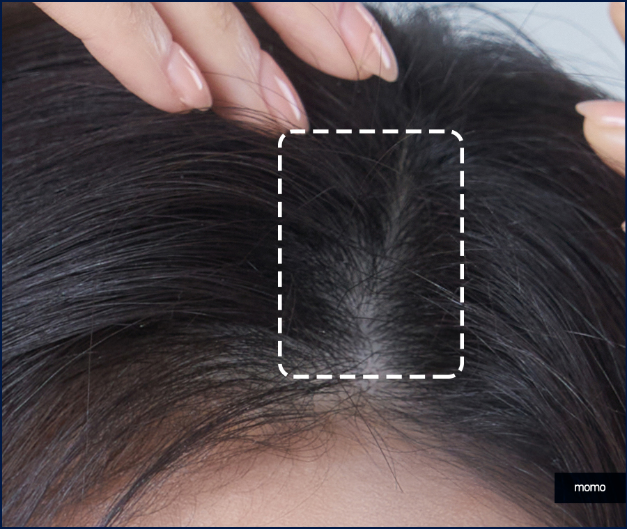 여자 정수리 탈모 모발이식 꼼꼼히 채우는 관련 이미지 3