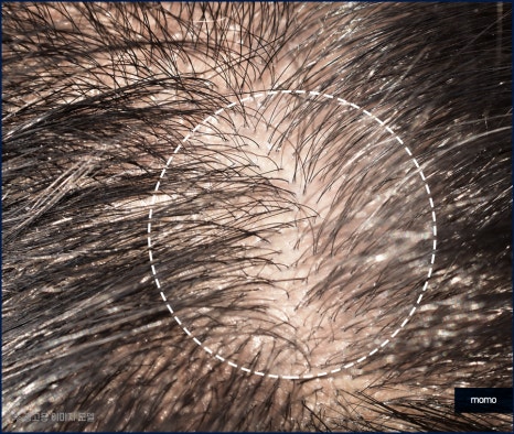 압구정 모발이식 외모 변화를 희망한다면 관련 이미지 3