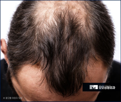 M자모발이식비용이 달라지는 기준과 방식의 차이에 대해 관련 이미지 7