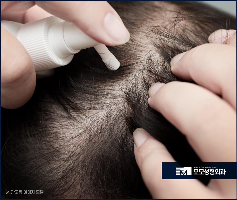 바르는미녹시딜효과 호전에 도움이 될까 관련 이미지 4