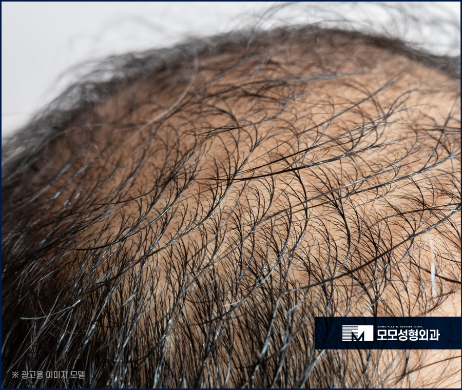 모발이식 붓기 지속 시간과 완화를 돕는 방안은 관련 이미지 2