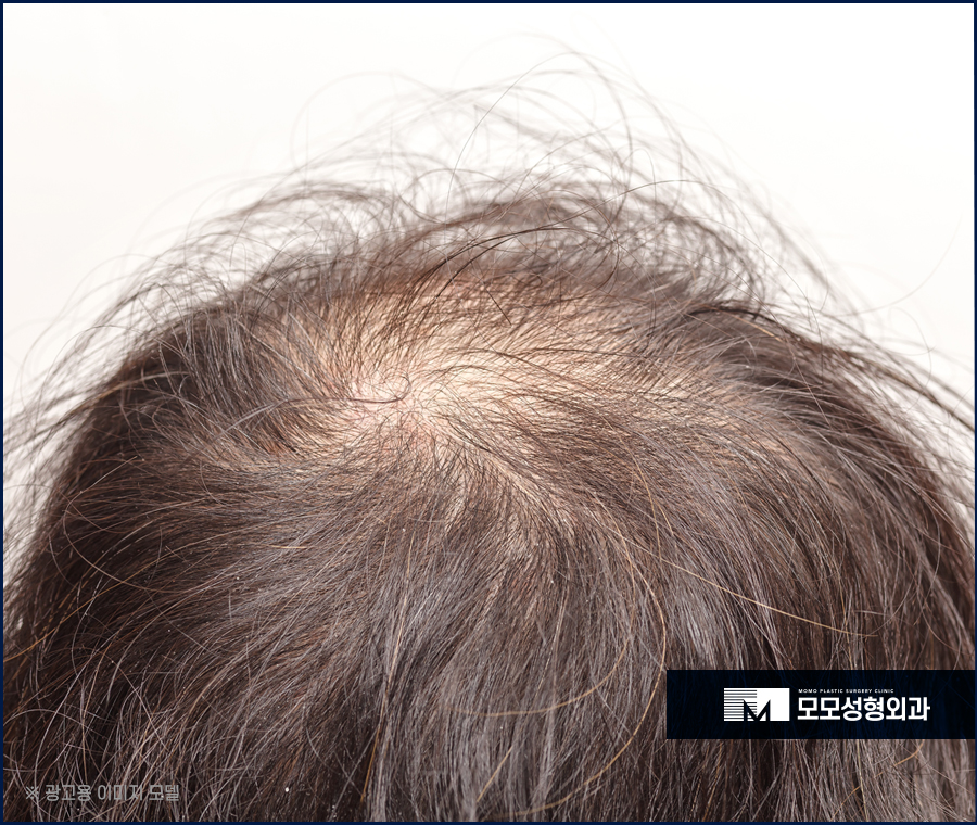 머리숱많아지는방법 효과를 기대하려면 관련 이미지 3