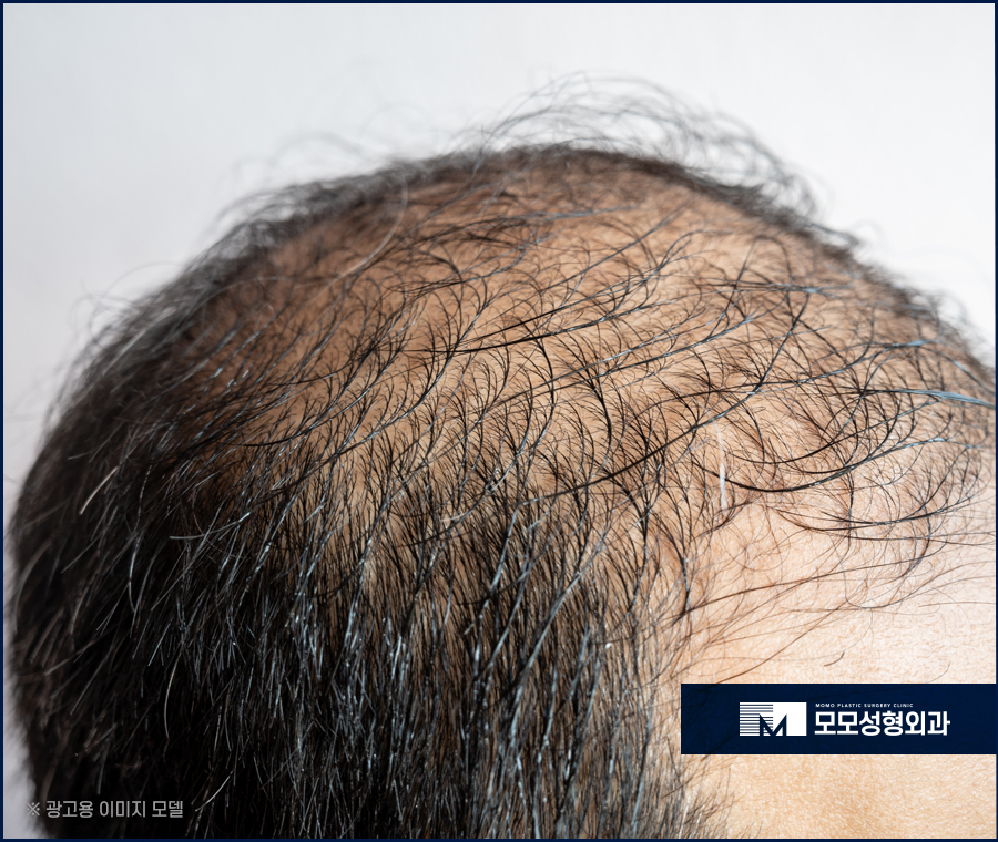 강남역모발이식 꼼꼼히 보강하기 위해서는 관련 이미지 3
