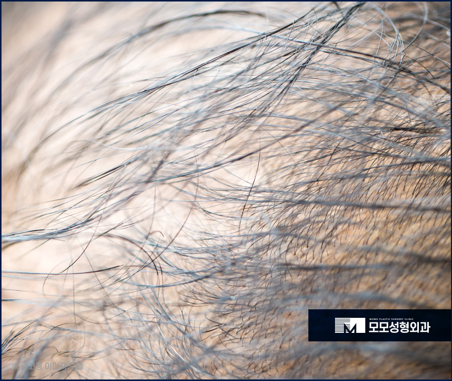 모발이얇아지는이유 그 원인부터 분명하게 알아야하는 관련 이미지 5