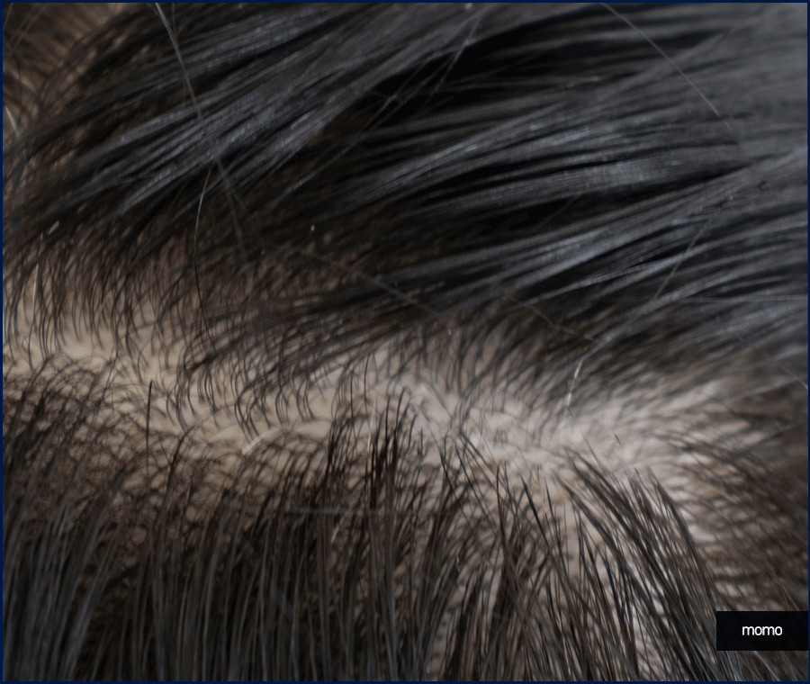 여자 가르마 탈모 모발이식으로 효과보려면? 관련 이미지 2