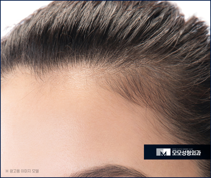 여자M자탈모치료 고민되는 상황에서는 관련 이미지 5