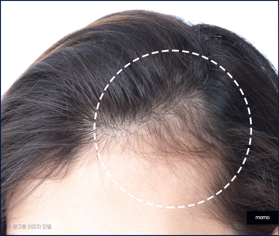 전두부탈모 원인과 시기, 해결 방안까지 관련 이미지 9