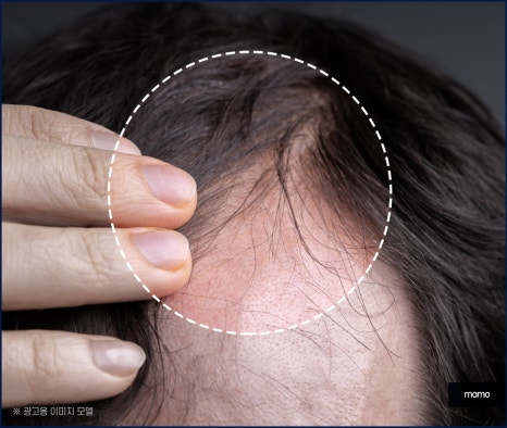 압구정 모발이식 외모 변화를 희망한다면 관련 이미지 6