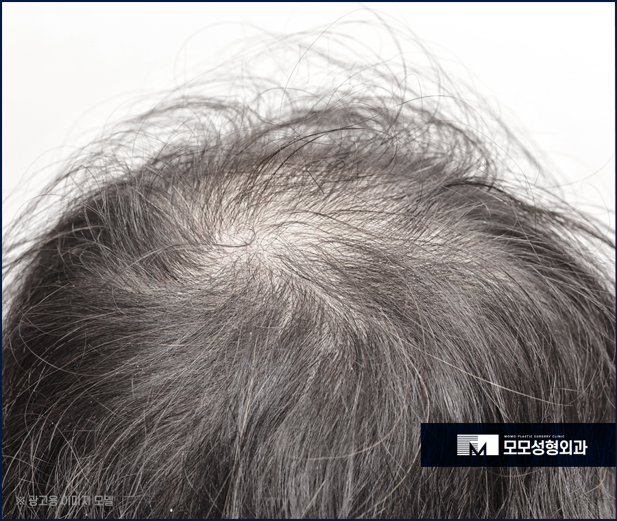 정수리탈모치료비용 모발이식을 기준으로 했을 땐 관련 이미지 4