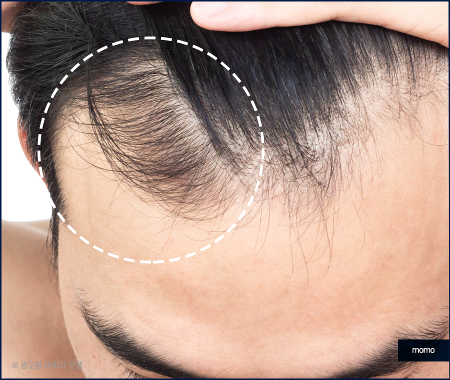 모발이식 후기 비교하며 섬세한 분석까지 해야만 관련 이미지 10