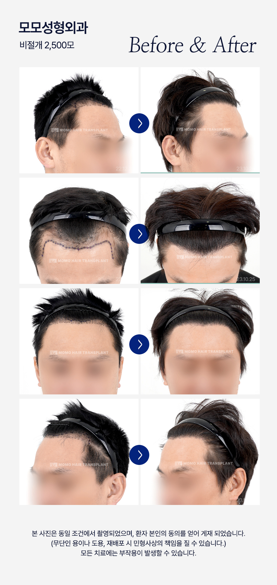 엠자탈모 약 진단과 처방으로 효과보기 위한 관련 이미지 16