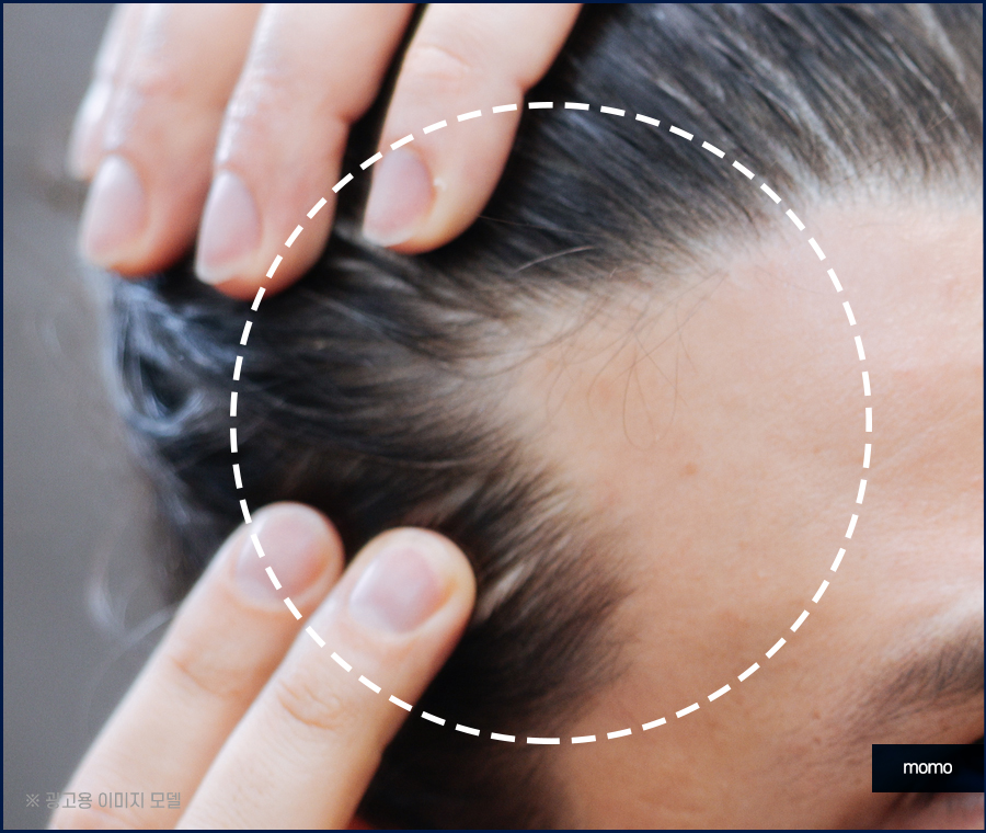 압구정 모발이식 건강한 두피를 만드는 방법 관련 이미지 6