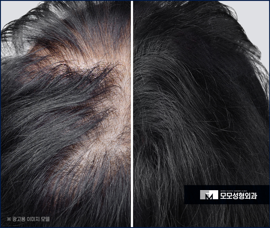 여성모발이식비용 알아 볼 때 고려해야 하는 점 관련 이미지 4