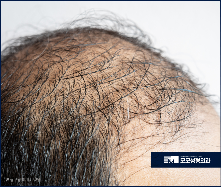 이승아원장 비절개 노컷 모발이식 관련 이미지 2