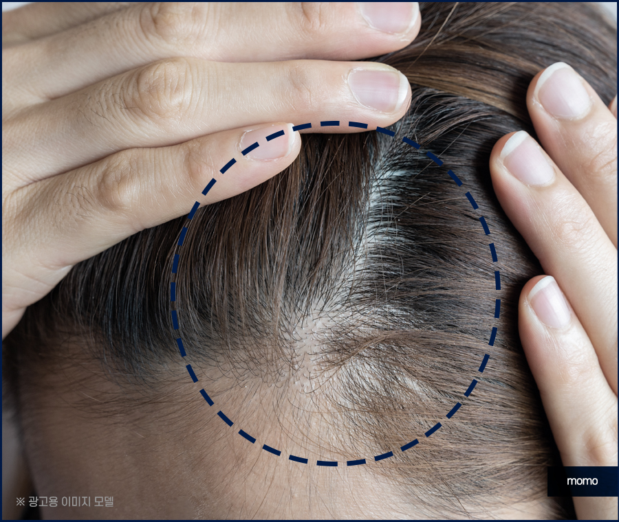 머리카락 얇아짐 발생하는 이유부터 회복 방안 관련 이미지 3