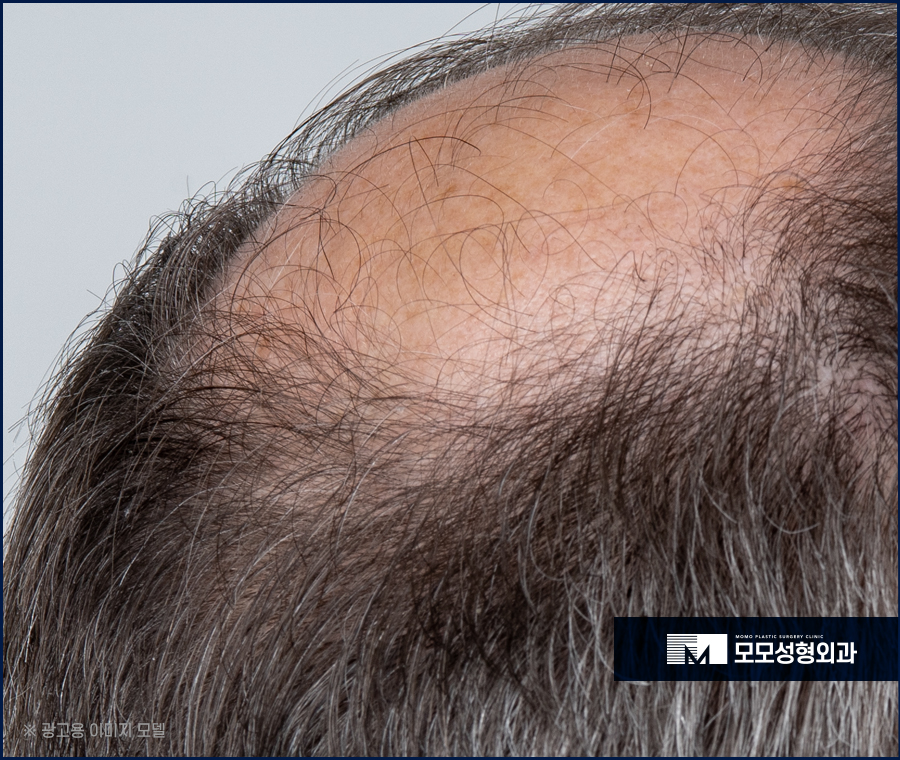 서울 모발이식 오랜 고민을 이겨내기 위한 선택 관련 이미지 3