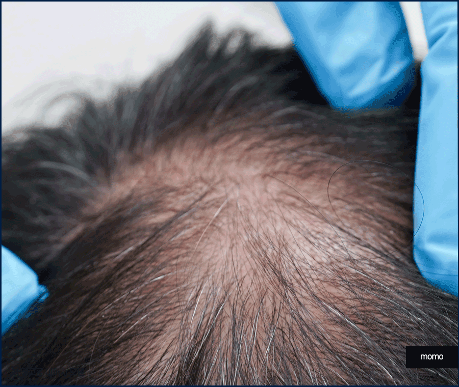 압구정 헤어라인 모발이식 라인 디자인으로 높인 완성도 관련 이미지 4