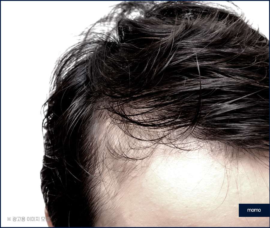 남자 헤어라인 교정 불규칙한 라인 보완을 위해 관련 이미지 5
