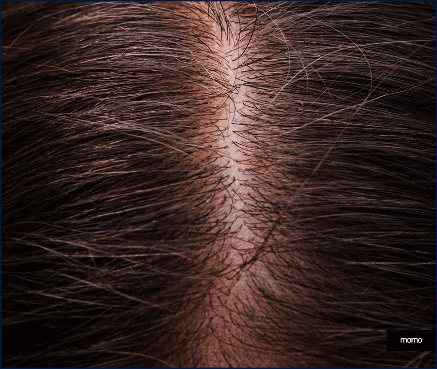 비절개모발이식가격 확인보다 중요한 점 관련 이미지 6