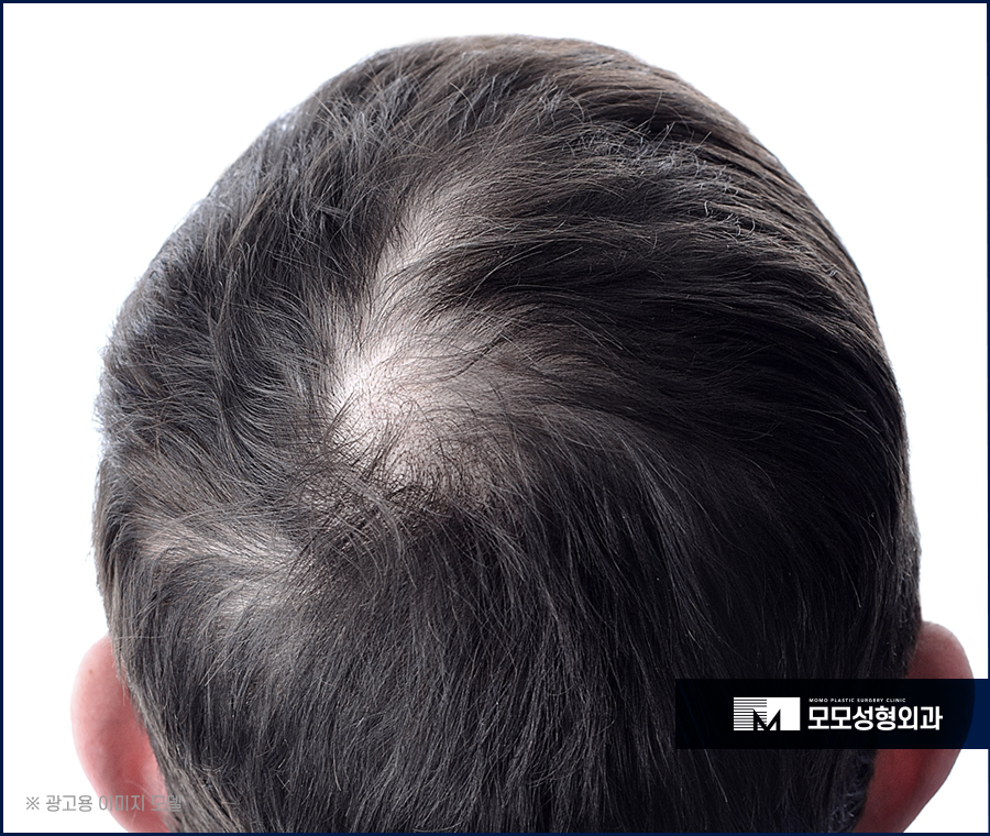 여름모발이식 망설이지 않아도 되는 이유 관련 이미지 3