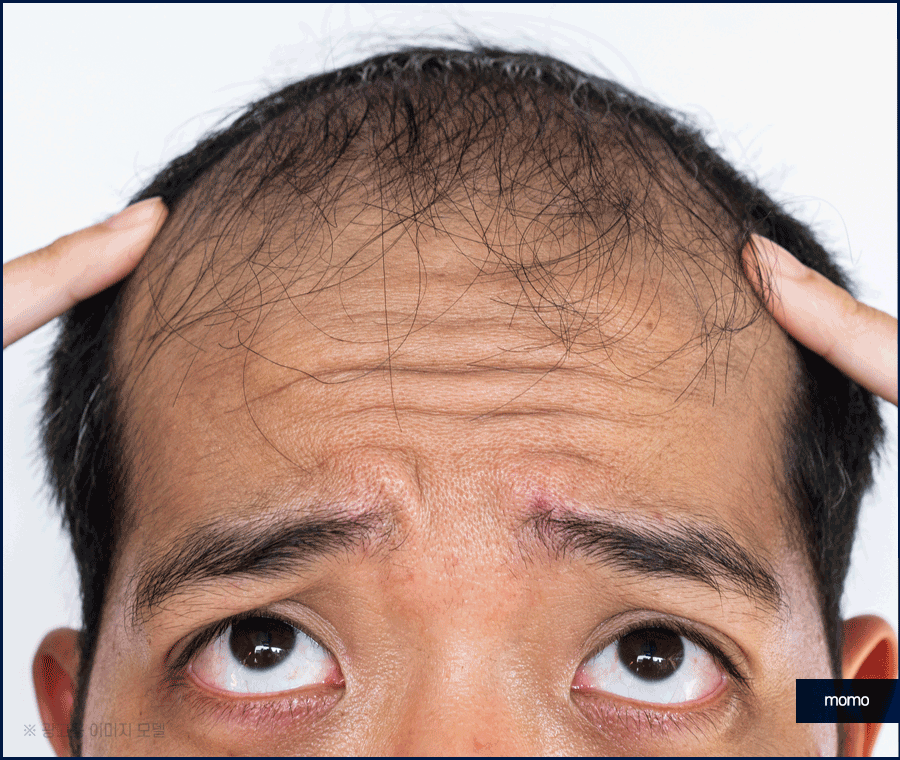 이마 축소술 비용 및 모발이식이 선호되는 이유 관련 이미지 10