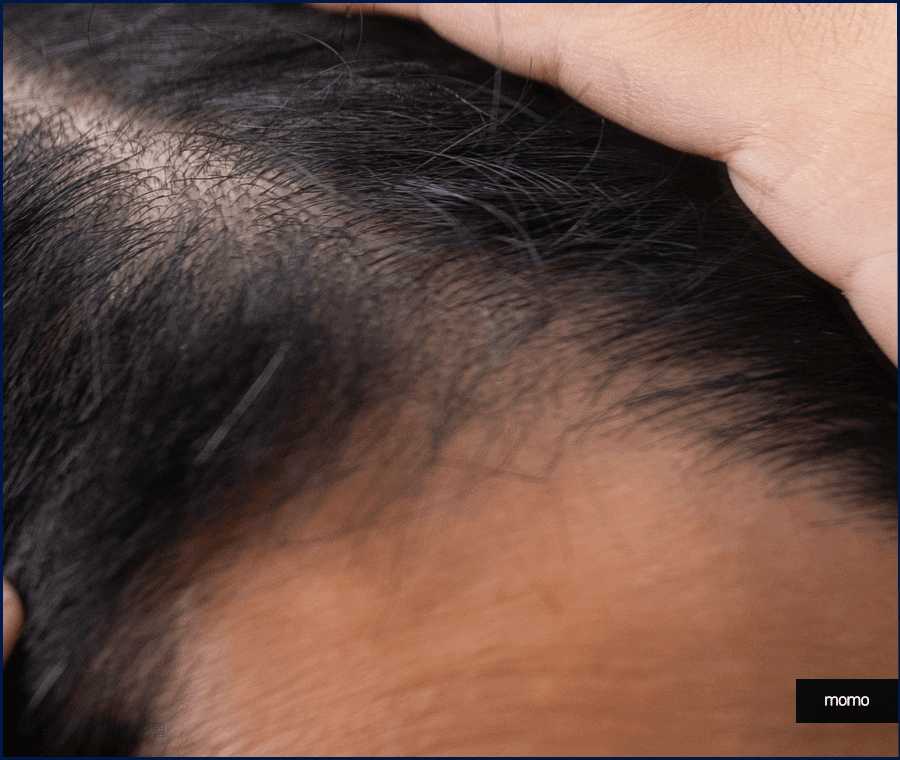 엠자 탈모 섬세하게 채워 만드는 변화 관련 이미지 11