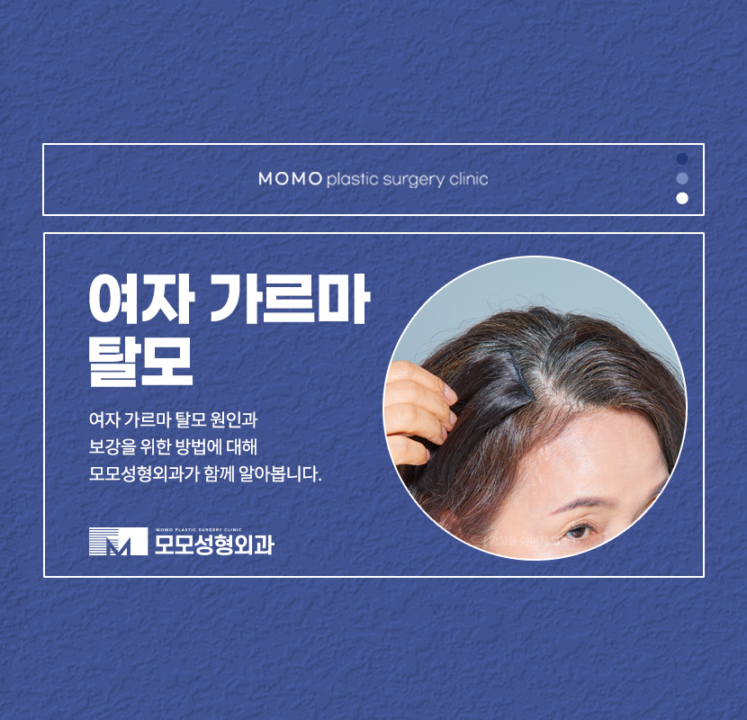 여자가르마탈모 숱을 채워가는 방향으로 관련 이미지 1