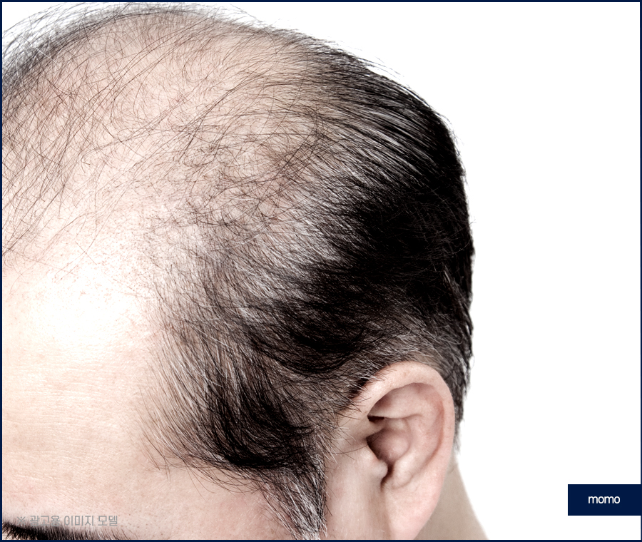 남자 헤어라인 교정 불규칙한 라인 보완을 위해 관련 이미지 7