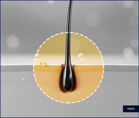 모발이식3000모비용 차이나는 이유 관련 이미지 4