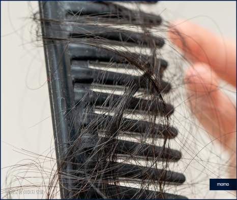 앞머리 모발이식 가격 차이부터 확인하며 관련 이미지 2