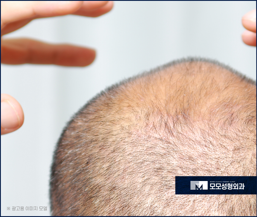 모발이식 암흑기를 이겨내기 위해 알아야 할 점 관련 이미지 6