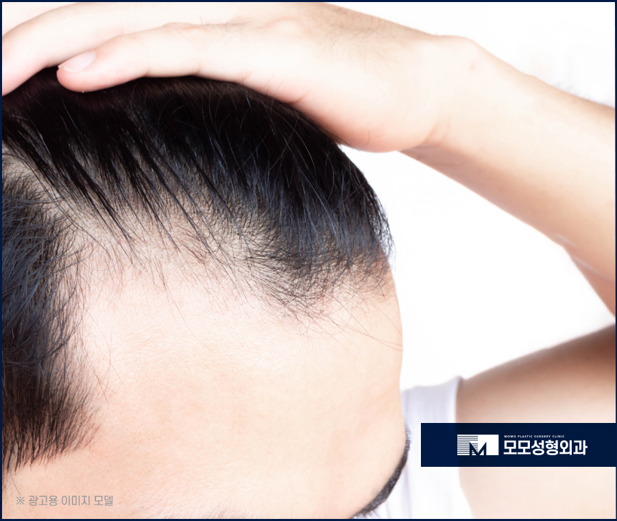 앞머리 모발이식 비용만큼 꼼꼼하게 알아봐야 할 점 관련 이미지 2
