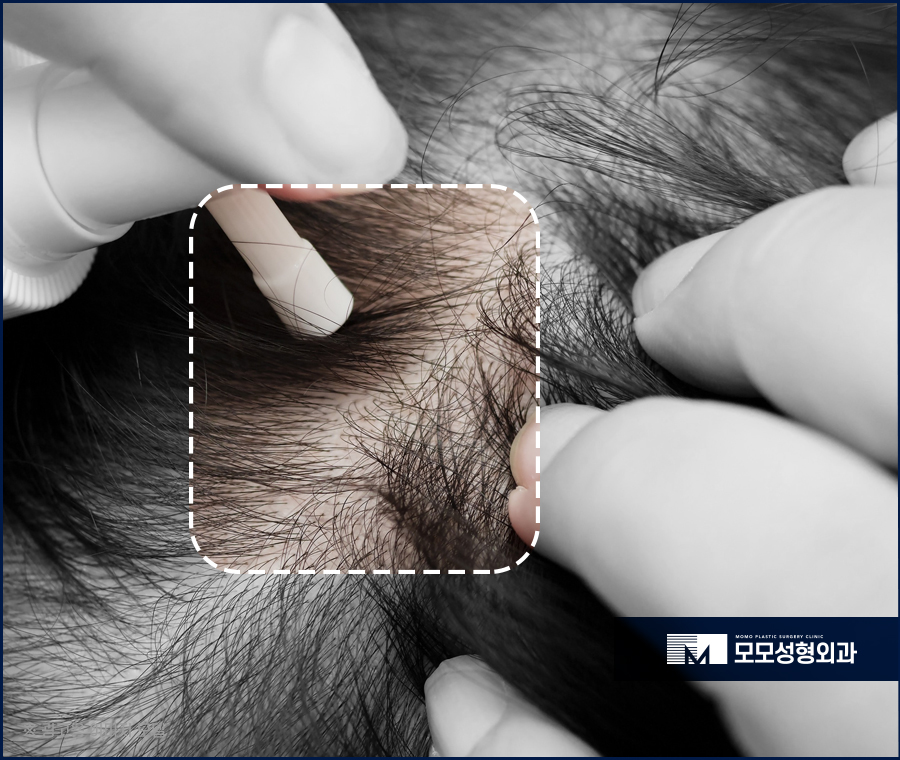 미녹시딜 5% 효과와 사용 전 알아두어야 할 점 관련 이미지 3