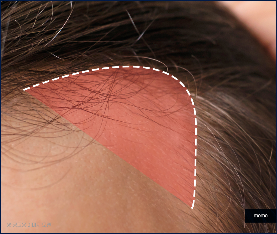 헤어라인모발이식비용 생착률을 높여가면서 관련 이미지 5