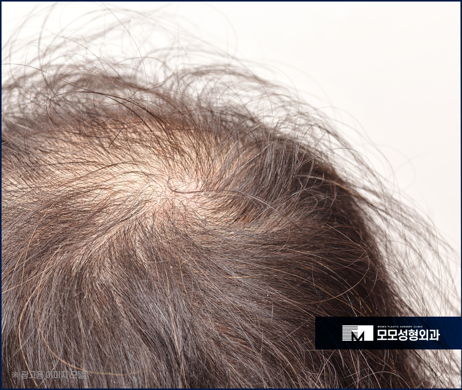강남탈모병원 진단부터 섬세한 곳에서 해야만 관련 이미지 3