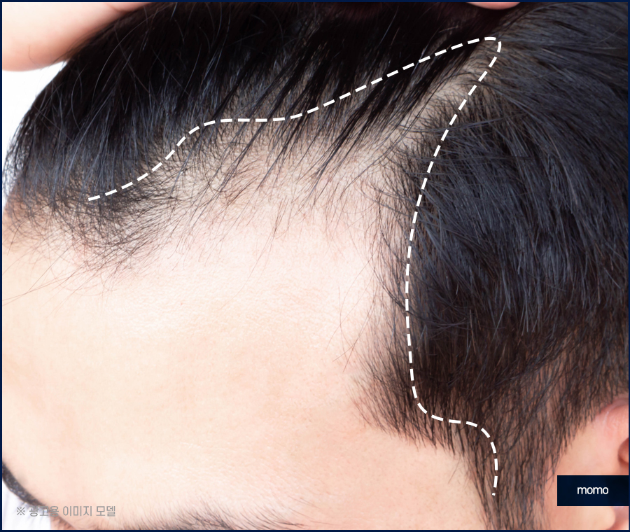 헤어라인 교정 비용 및 방법 디자인의 중요성 관련 이미지 10