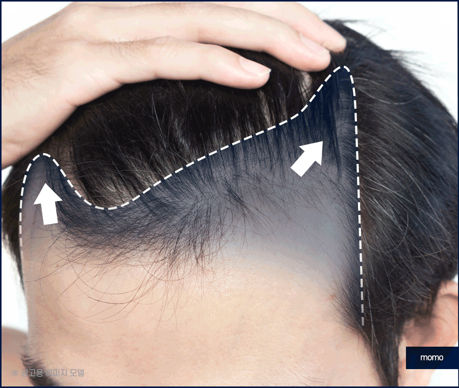남자헤어라인모발이식 디자인의 중요성 관련 이미지 6