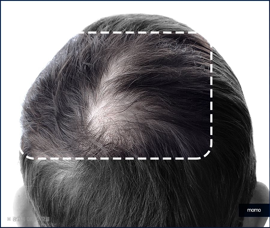 서울모발이식병원 나아지는 과정은 관련 이미지 4