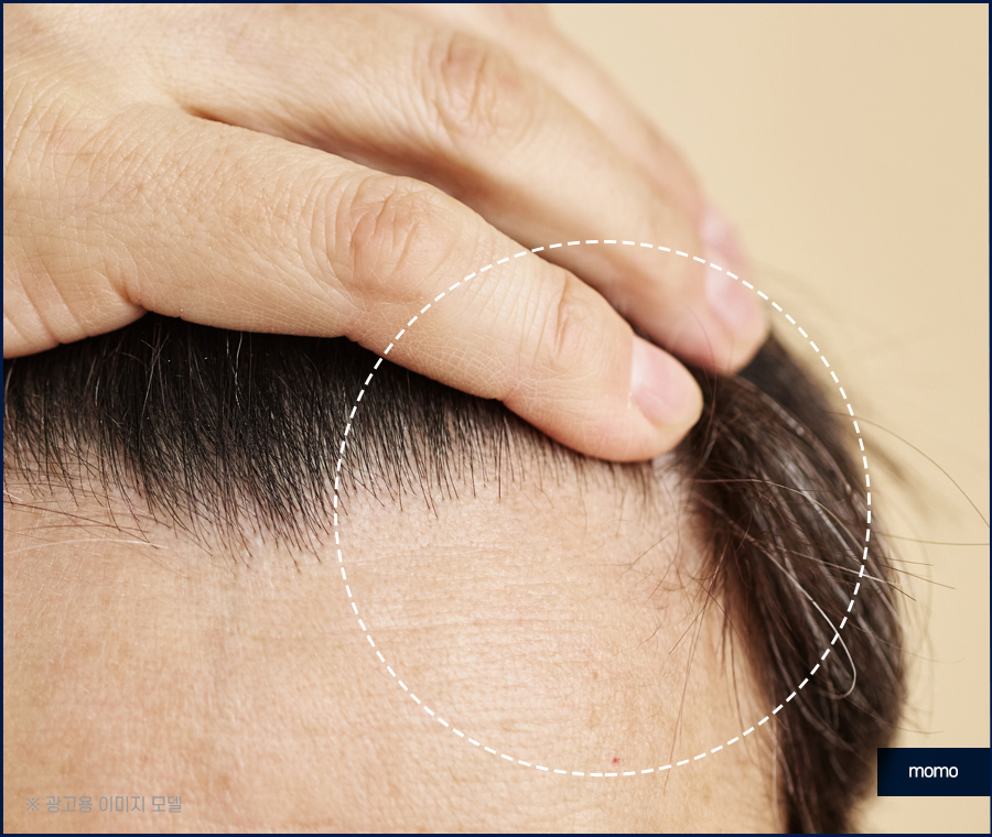 이마 머리 심기 넓은 모습을 보완하기 위한 관련 이미지 6