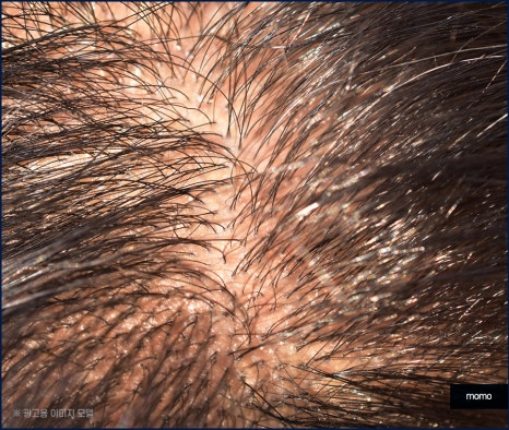 탈모약 부작용 증상 및 주의해야 할 사항 관련 이미지 3