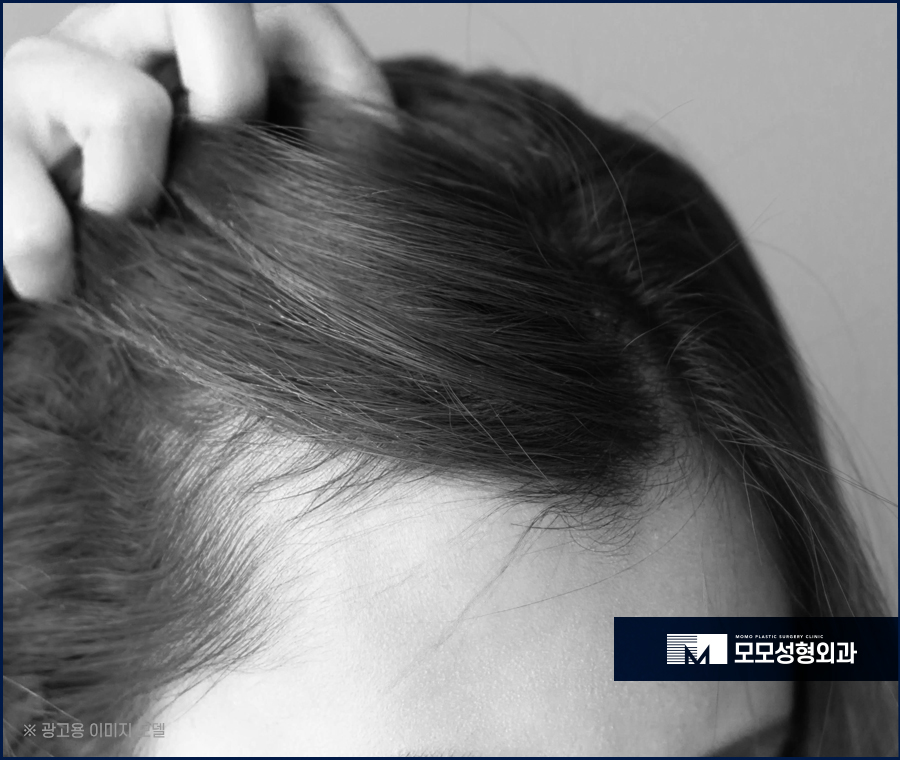 여자 헤어라인 모발이식 부작용 발생 우려를 낮춰야만 관련 이미지 2