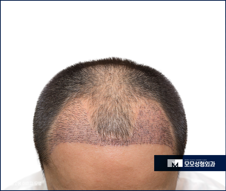 모발이식2주가 되면 어떤 변화가 찾아올까요 관련 이미지 3