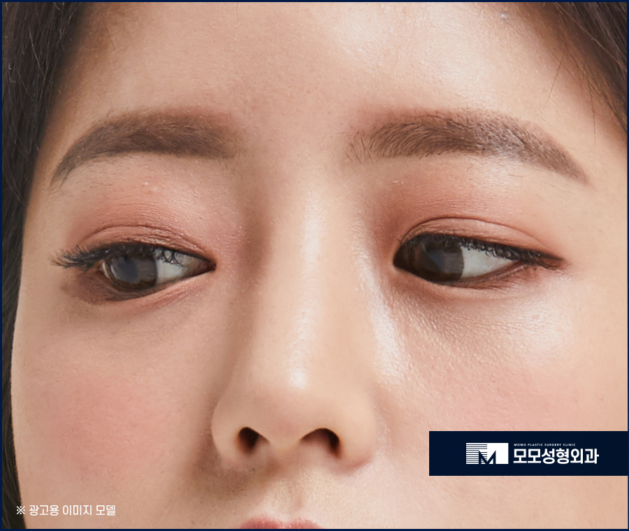 눈매교정 후 관리 철저하게 이뤄져야 관련 이미지 2