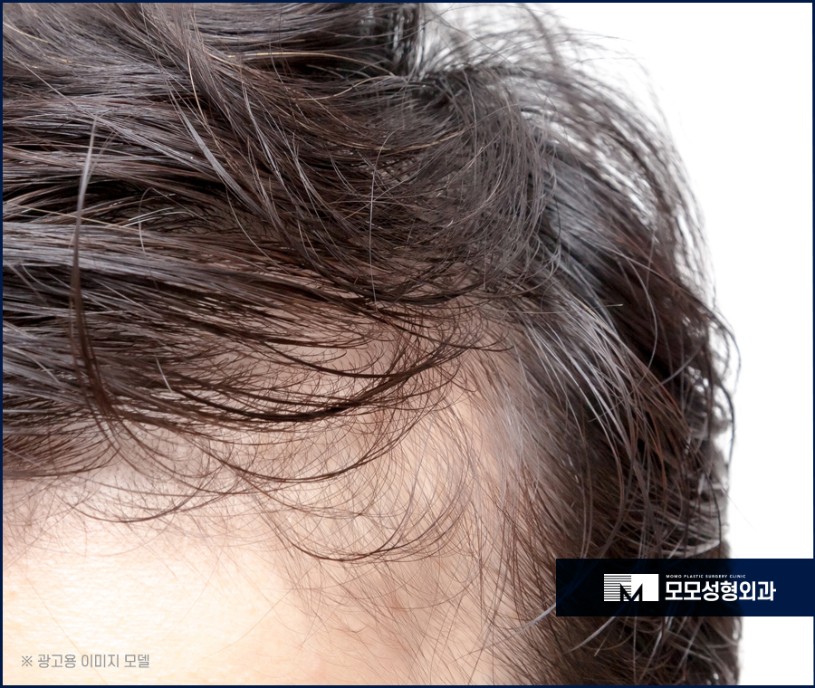 신사동 모발이식 헤어스타일을 자유롭게 연출하기 위한 관련 이미지 2